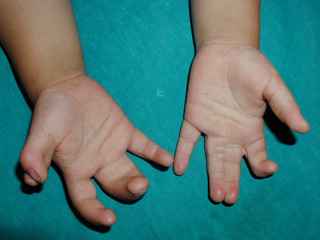 Сколько срастается палец на руке